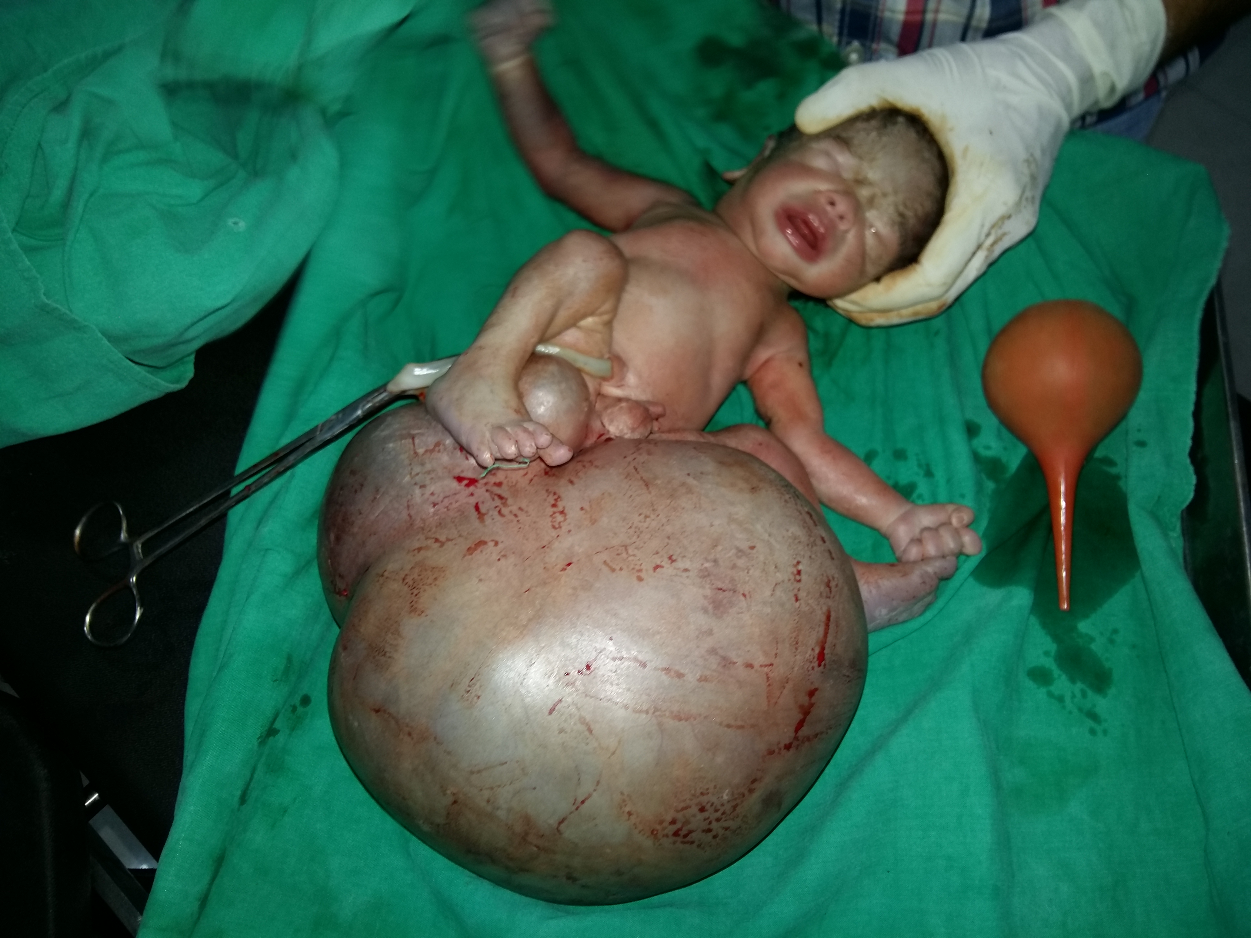 An Unusual Case Of Sacrococcygeal Teratoma